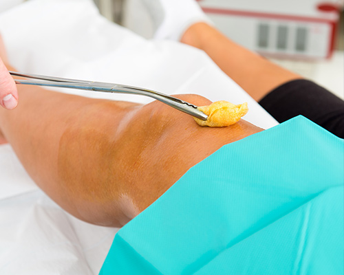 Total knee replacement