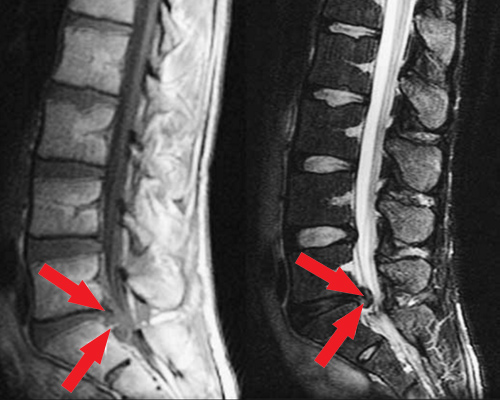 Lumbar disc herniation