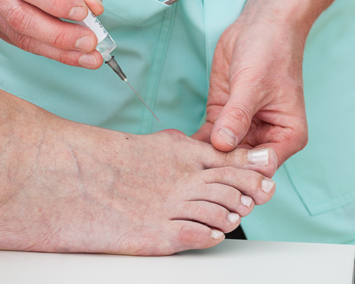 Hallux valgus