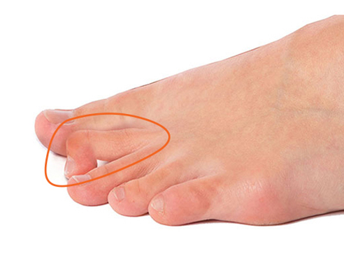 Hammer toes
