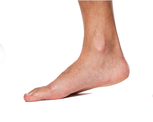 Flatfoot endorthesis