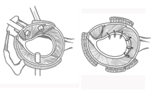 Rotator cuff repair